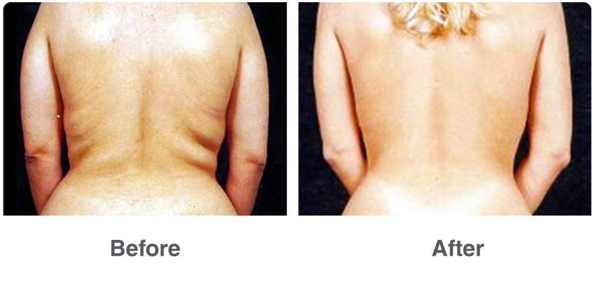 before-after-vaser-liposuction1a