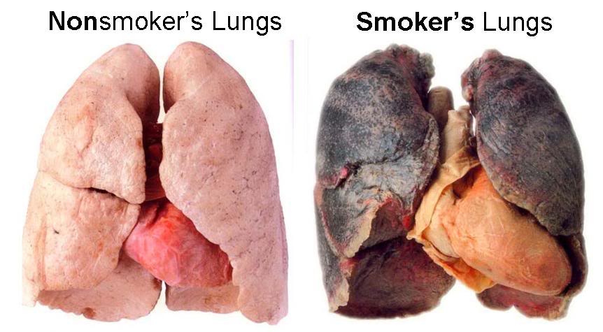 lungs-of-a-smoker