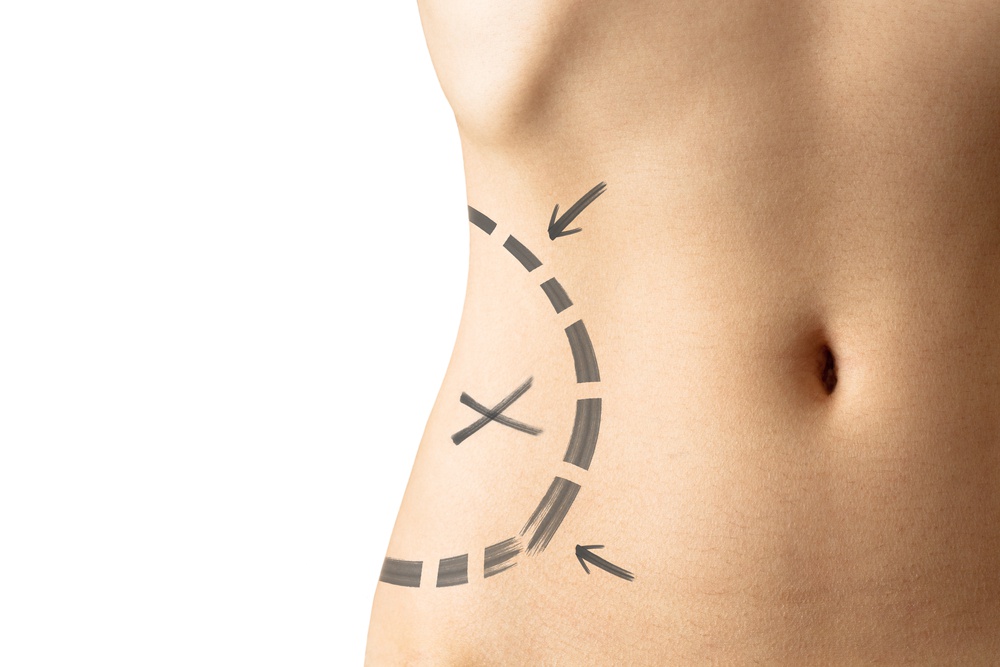 liposuction-and-the-perfect-body