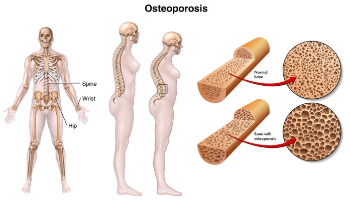 Osteoporosis-image