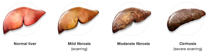 1.2.1_Stages_of_liver_disease