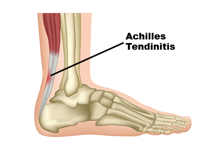 achilles-tendonitis1